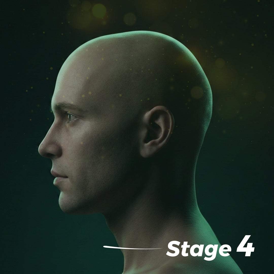 Stage Four Hair Loss