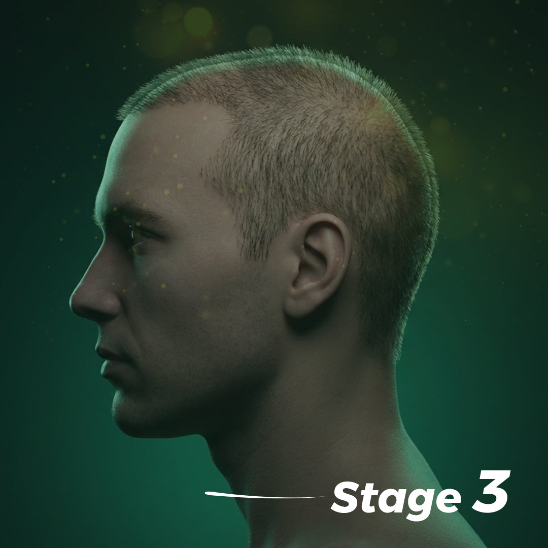Stage Three Hair Loss